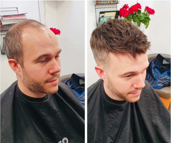 Mens Hair Replacement 