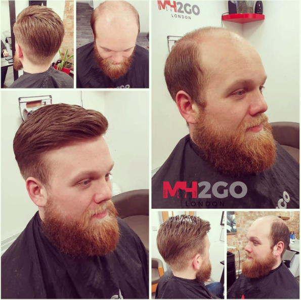 Mens Hair Replacement 