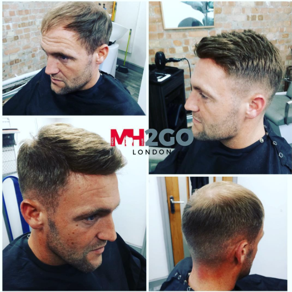 Mens Hair Replacement 